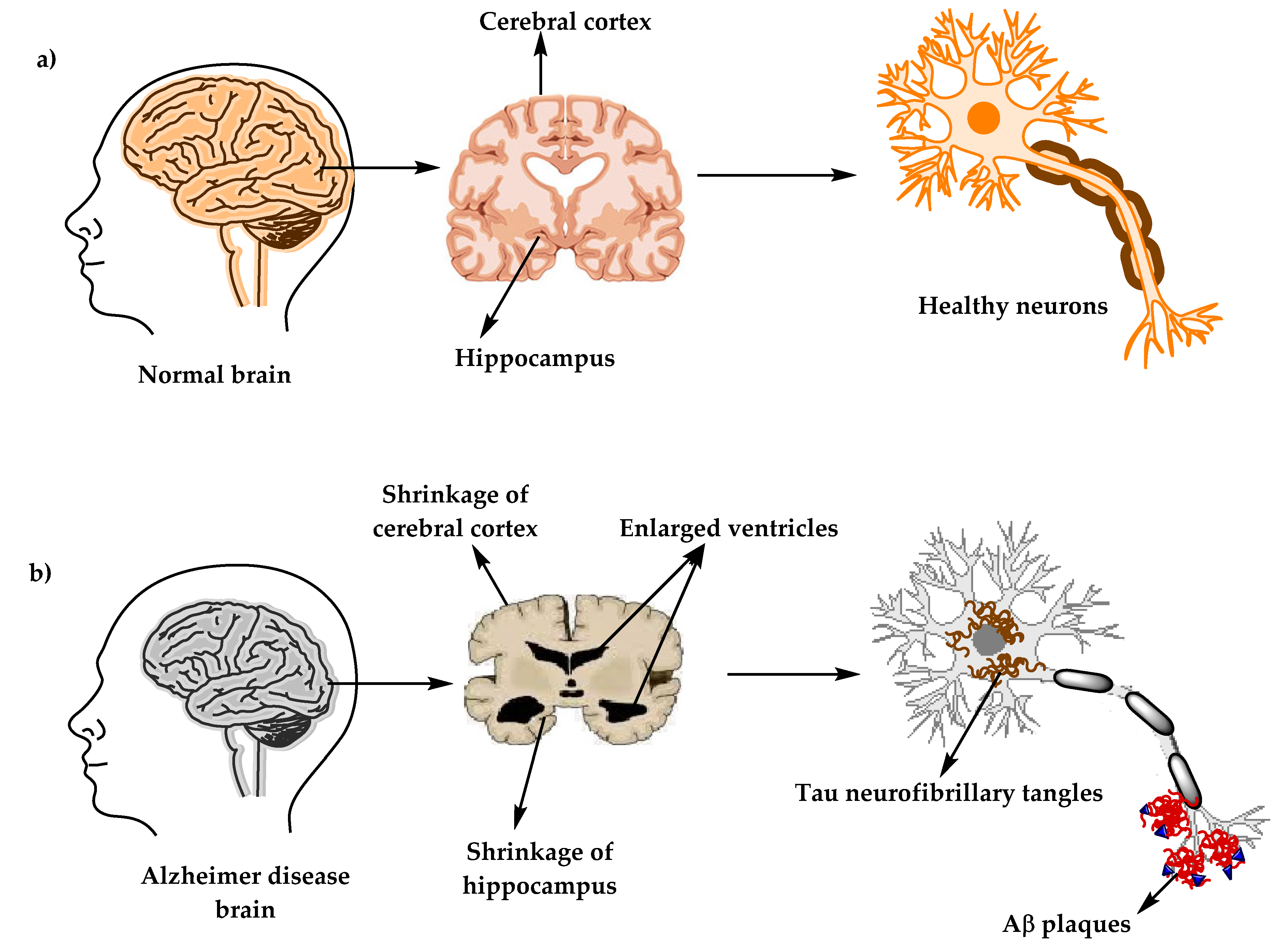 Alzheimer’s Disease