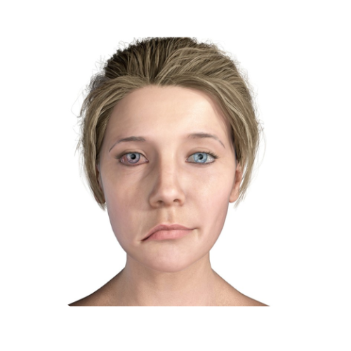 Bell’s Palsy