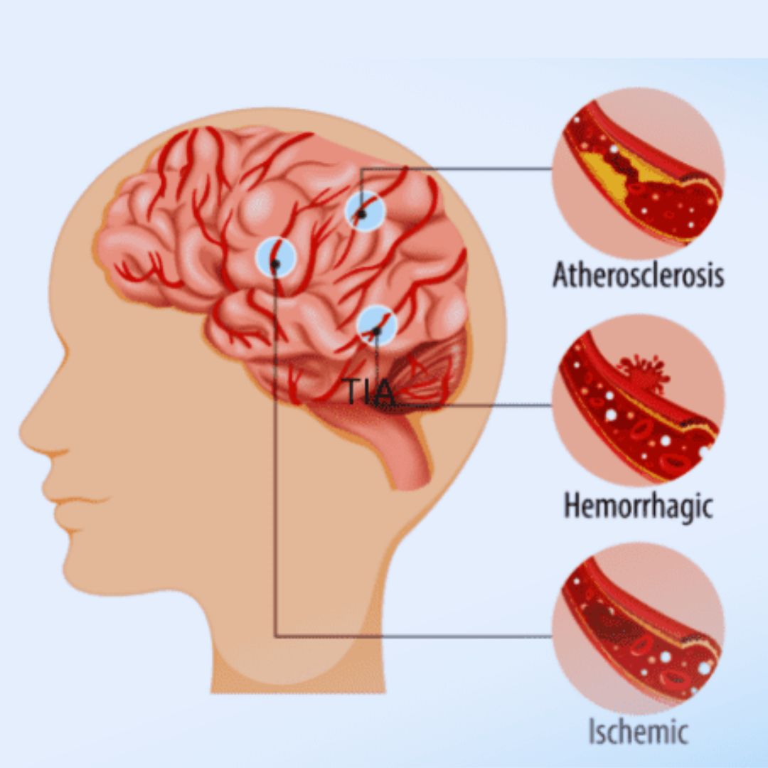 Brain Stroke (Paralysis)