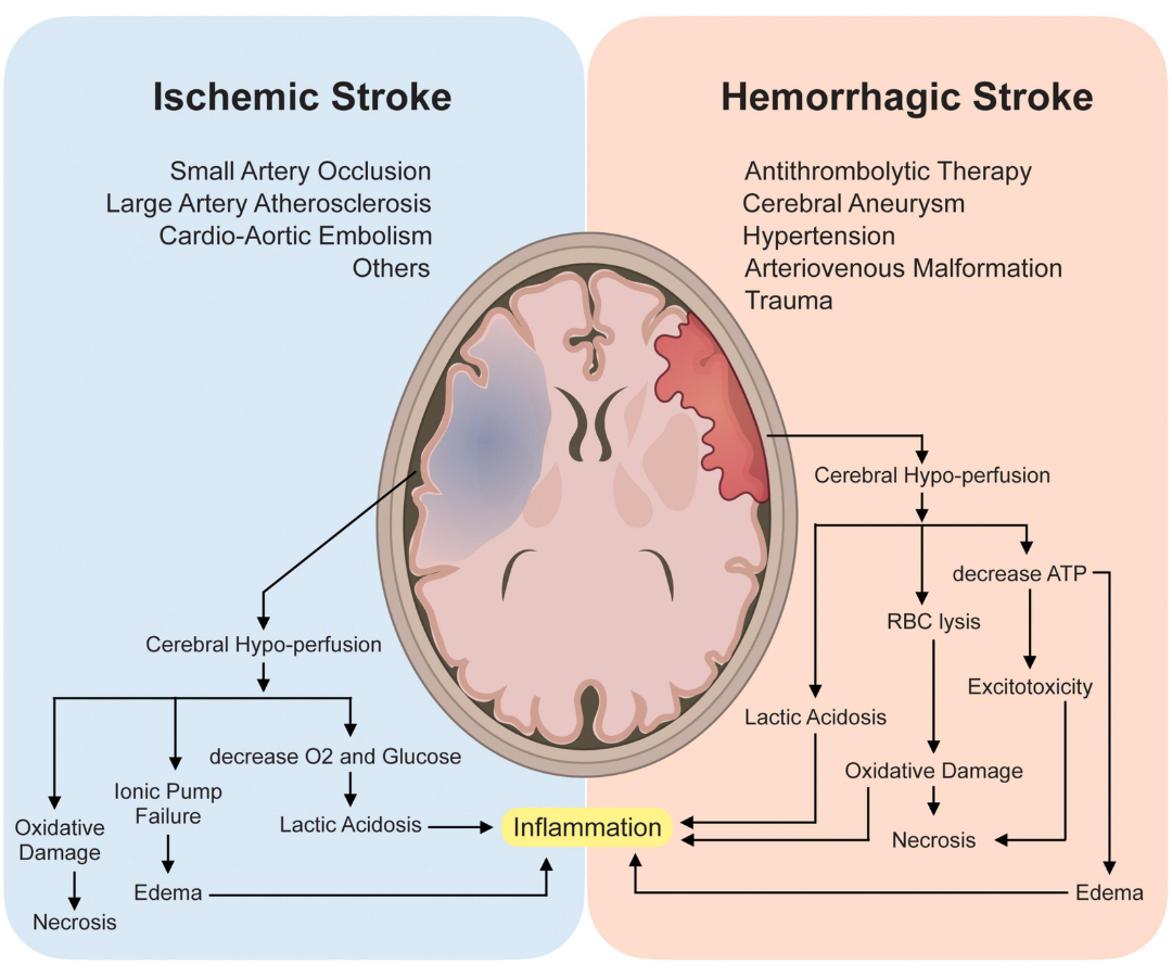 Brain Stroke