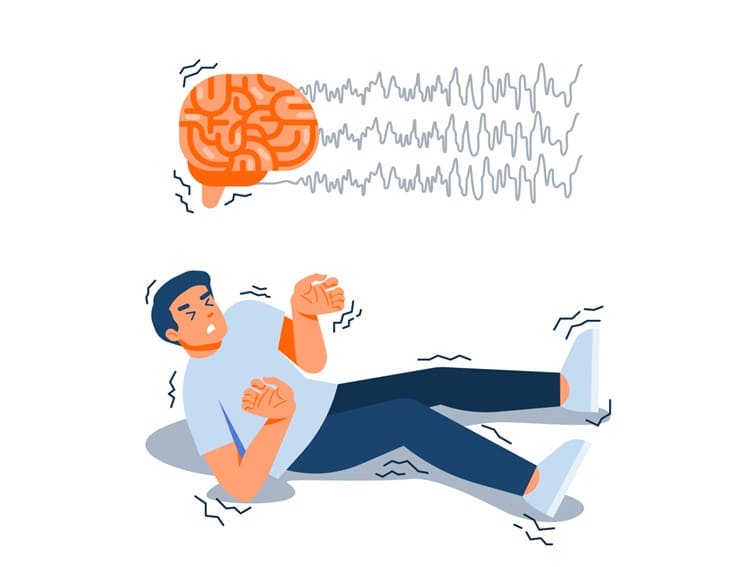 Epilepsy