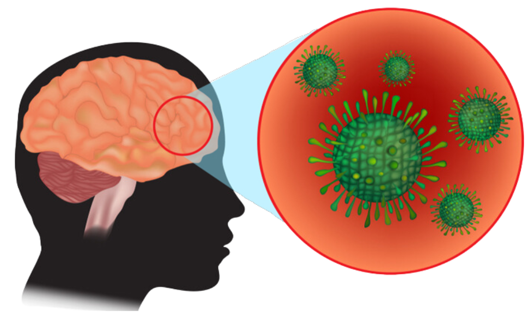 Meningitis & Encephalitis