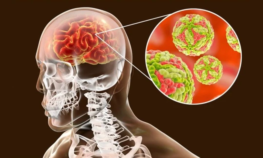Meningitis & Encephalitis