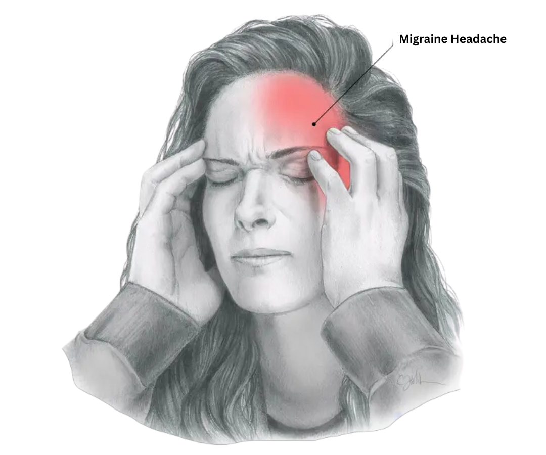 Migraine Headache