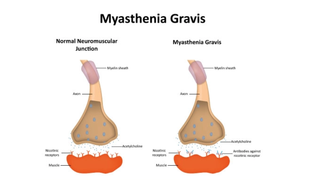 Myasthenia Gravis