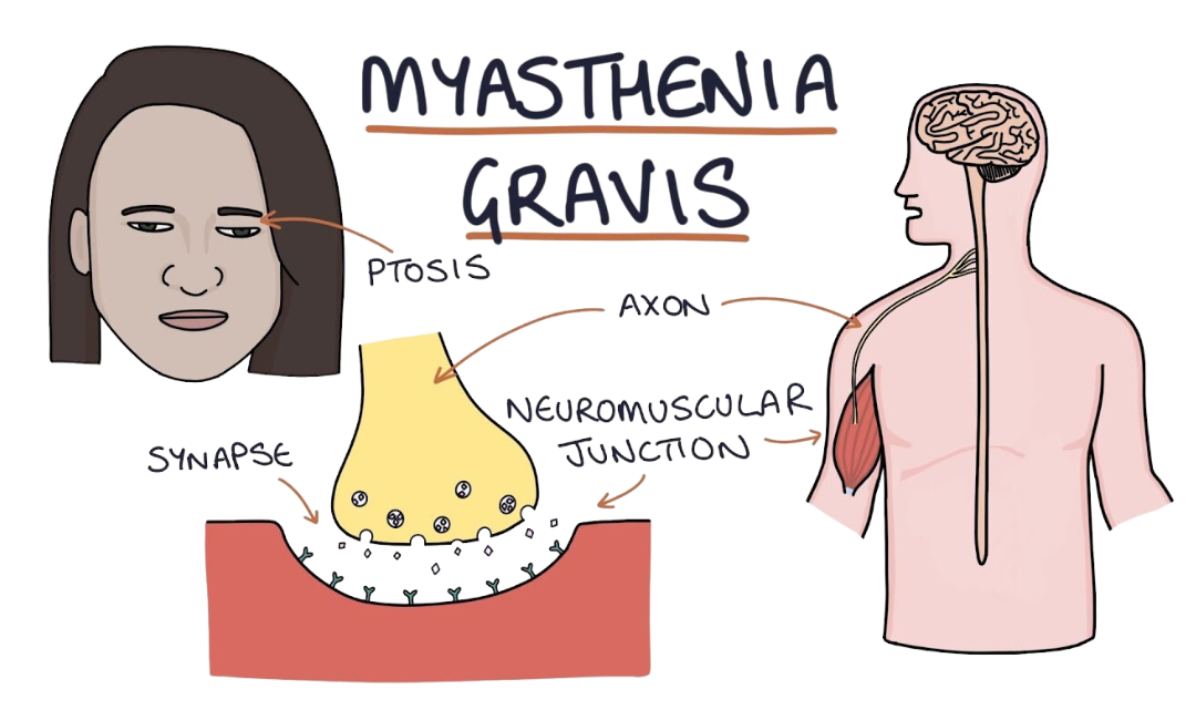 Myasthenia Gravis