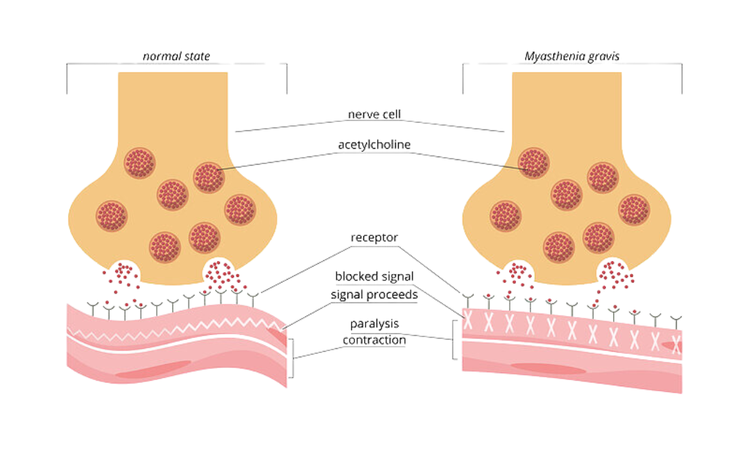Myasthenia Gravis