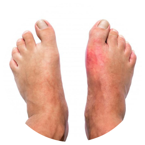 Neuropathy 