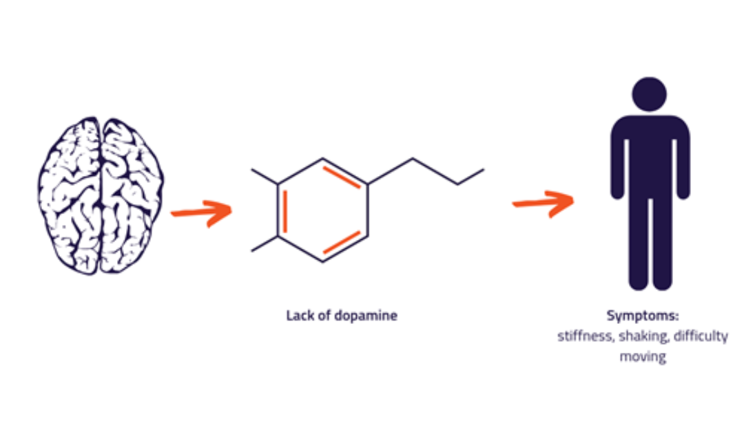 Parkinson’s Disease